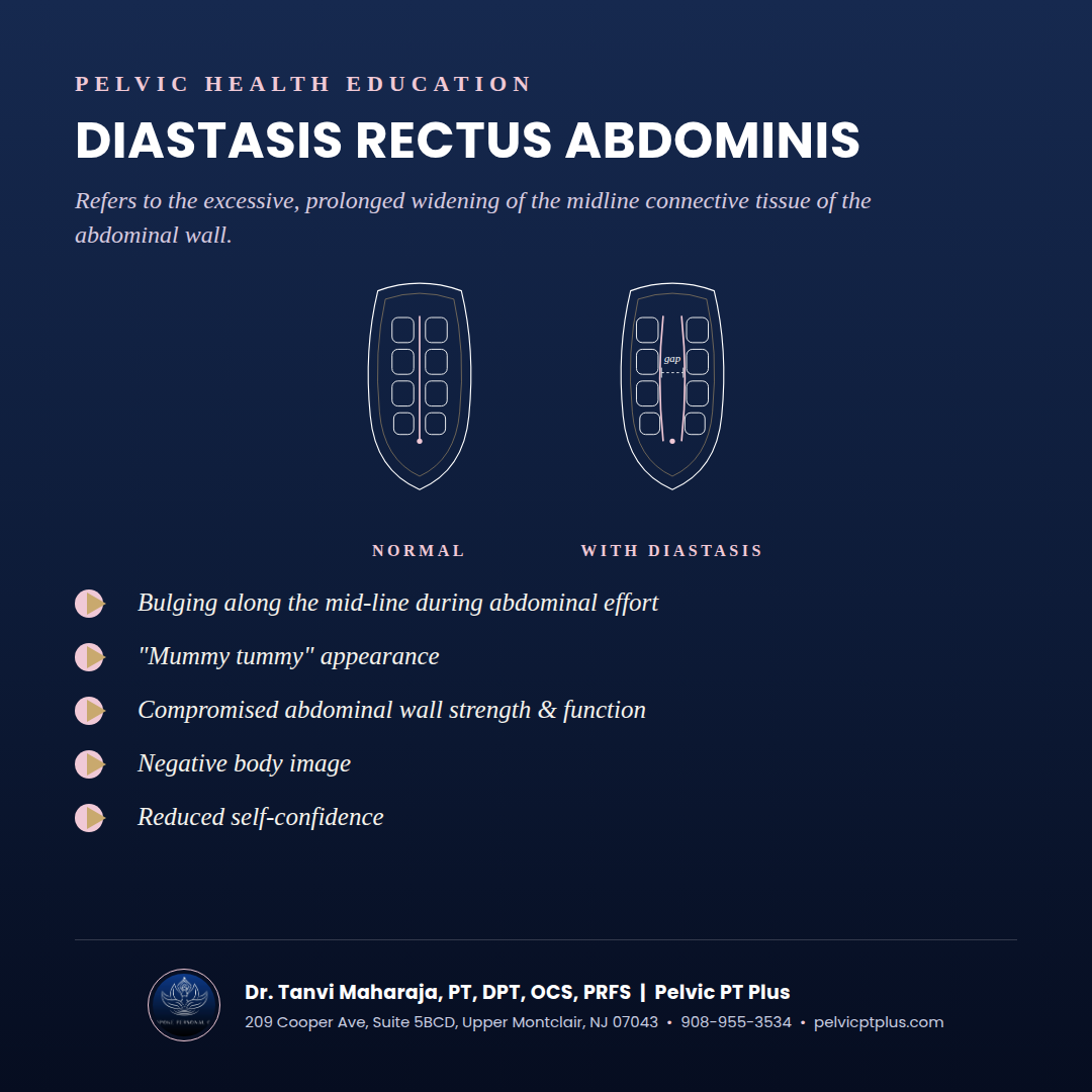 Clinical illustration of a normal abdominal wall and an abdominal wall with diastasis recti, with common signs listed